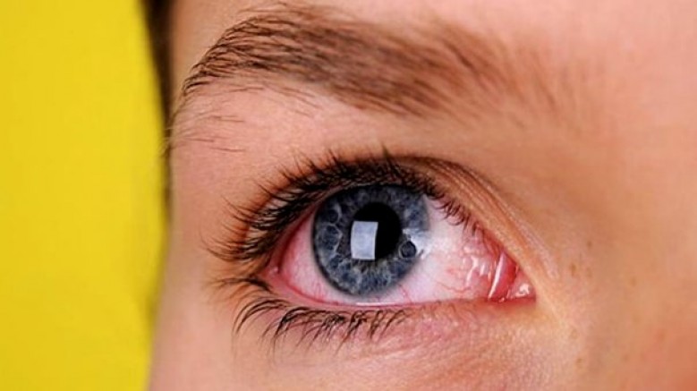 'Göz tansiyonu (glokom); belirti vermeye başladığında, yaklaşık yüzde 30-35 sinir hücresi kaybı olmuştur ve bu hücre kaybı, geri dönüşsüzdür'