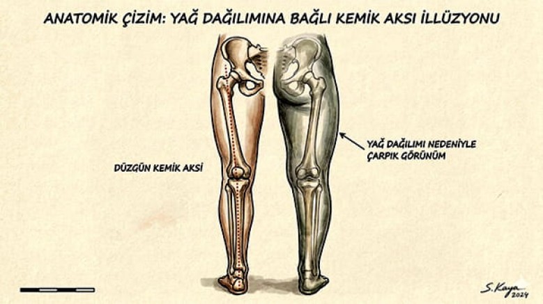 Çarpık bacaklara kemik kırmadan çözüm