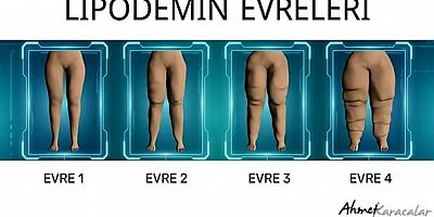 İlkel çağlardan gelen 'Hayatta Kalma' geni; lipödem